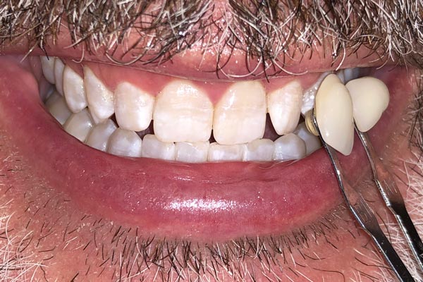 Teeth Whitening Dentist Grand Rapids